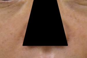 다크서클 치료 2